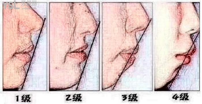 成年后骨性突嘴還能改善嗎？不想手術能戴牙套矯治不？不想手術看你能戴牙套矯治不！