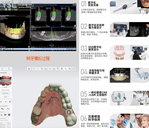 什么是3d數(shù)字化導(dǎo)板種植牙，3d數(shù)字化導(dǎo)板種植牙的作用和費(fèi)用