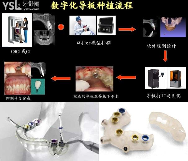 什么是3d數(shù)字化導(dǎo)板種植牙，3d數(shù)字化導(dǎo)板種植牙的作用和費(fèi)用