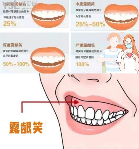 露齦笑矯正前后對比
