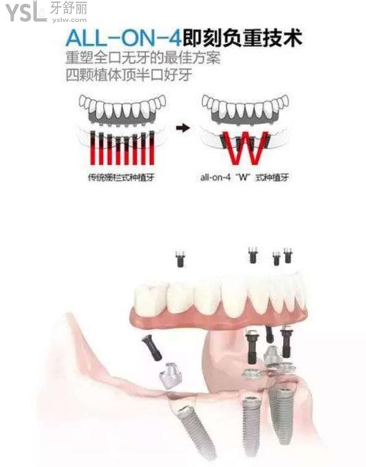 all-on-4半口即刻負(fù)重種植技術(shù)