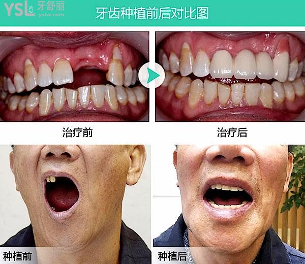 良心醫(yī)生不建議種植牙的緣由為什么，那建議用啥方法呢？