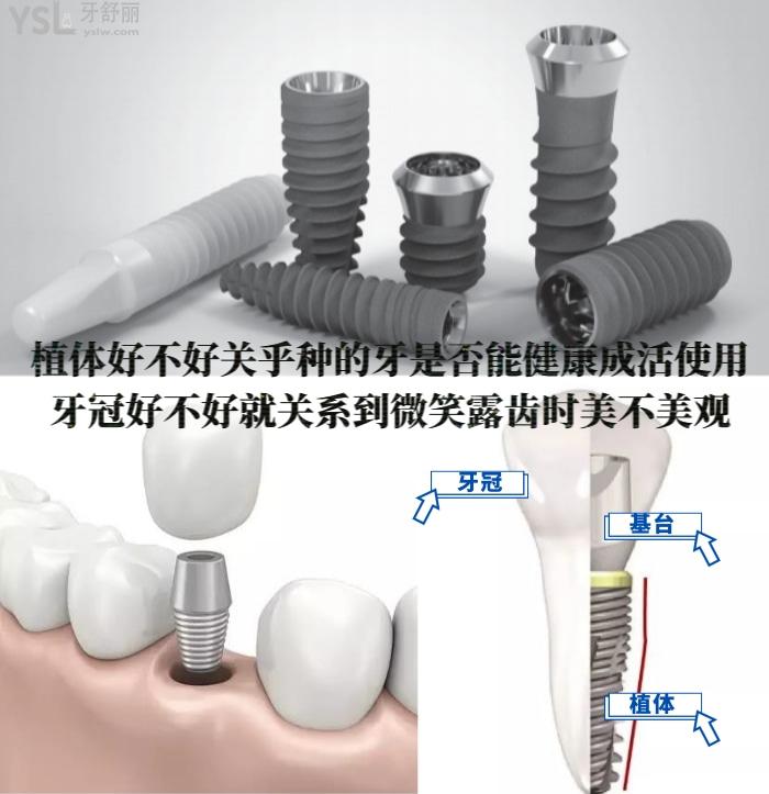 老人安裝全口假牙多少錢？北京朝陽(yáng)區(qū)種植牙哪個(gè)醫(yī)院便宜又好？