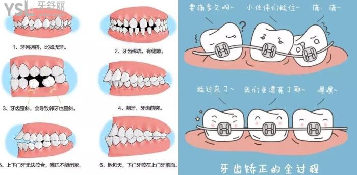牙齒矯正的難度分級標準是什么？重度牙齒畸形可以用隱形牙套嗎？