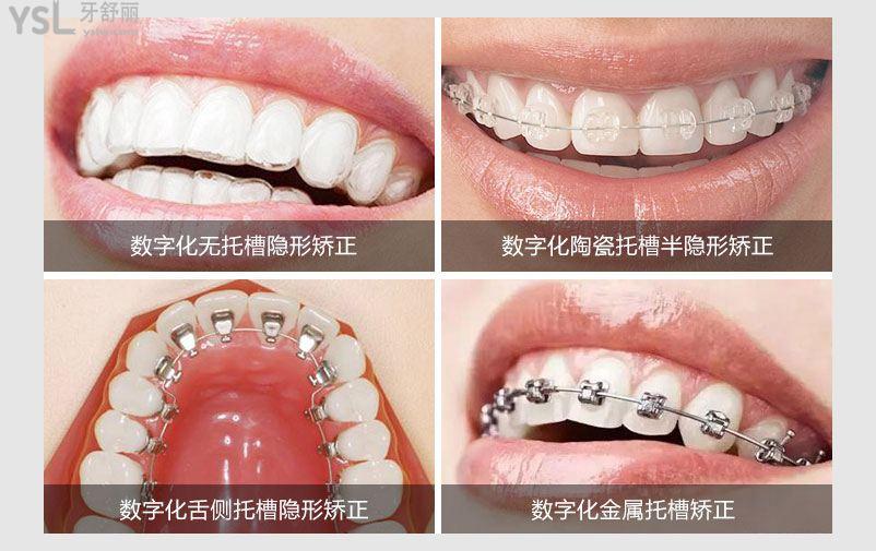 牙齒矯正的難度分級標準是什么？重度牙齒畸形可以用隱形牙套嗎？
