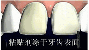 超模瓷貼面和全瓷貼面的區(qū)別是什么，牙貼面多少錢，牙貼面有什么后遺癥嗎
