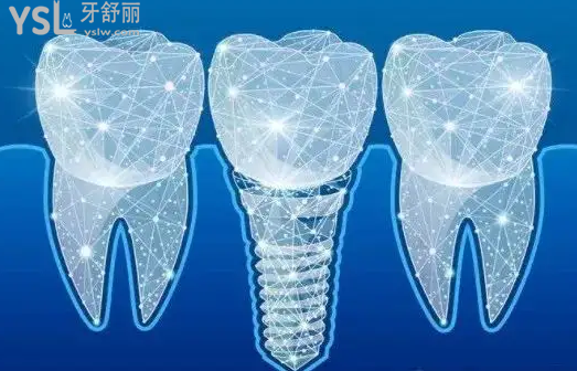 種植牙納入醫(yī)療保險進展！2022種植牙醫(yī)改及集采政策！