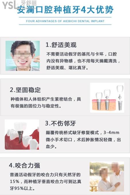 常熟安瀾口腔種植牙優(yōu)勢