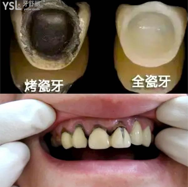西安做牙冠什么價(jià)位.jpg