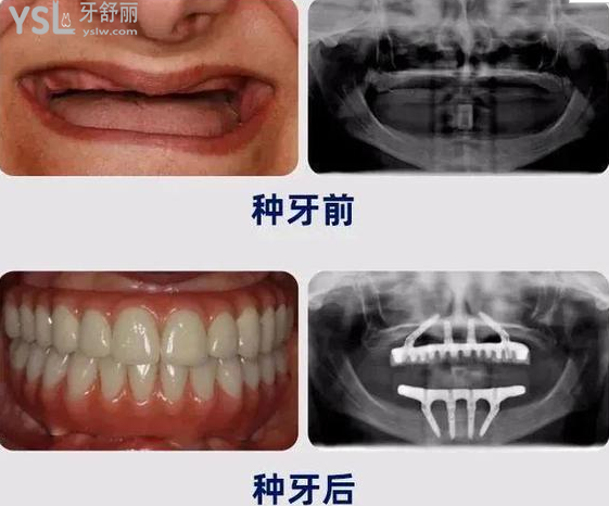 請把這條大數(shù)據(jù)推給缺牙的人，福州維樂口腔醫(yī)院幫助缺牙人士重拾口福！