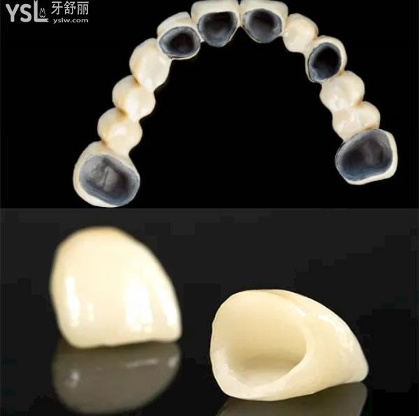 西安烤瓷牙的價(jià)格一顆多少錢.jpg