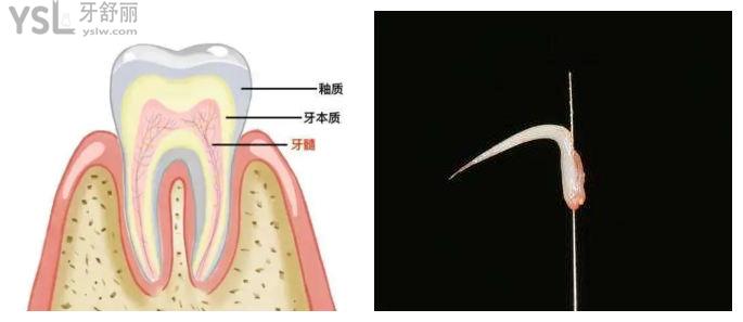 太后悔做根管治療！千萬不要隨便做 做完一顆牙齒就完了
