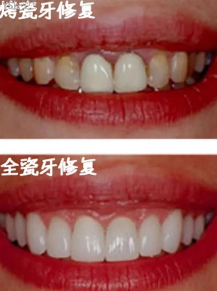 昆明做全瓷牙多少錢一顆