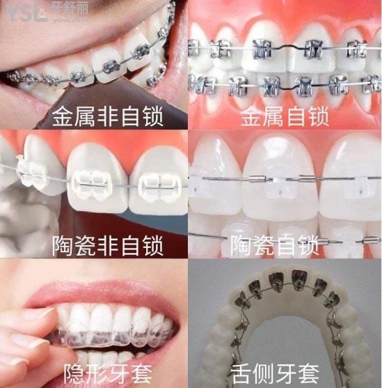 西安隱形牙套費用大概多少