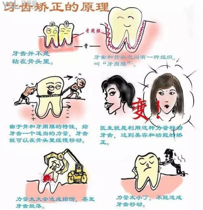西安隱形牙套費用大概多少
