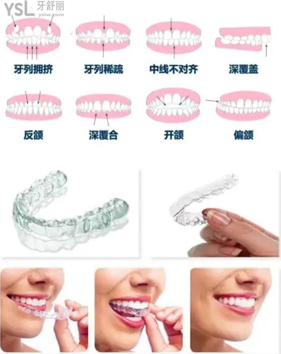 隱形矯正圖