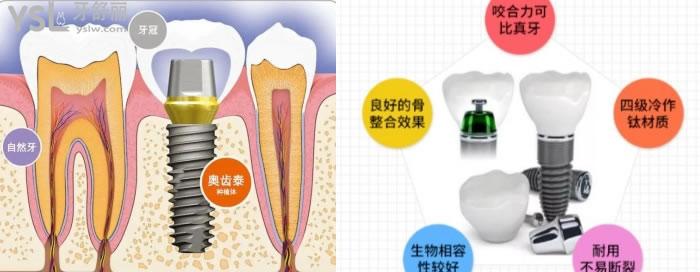 韓國奧齒泰種植體是純鈦的嗎