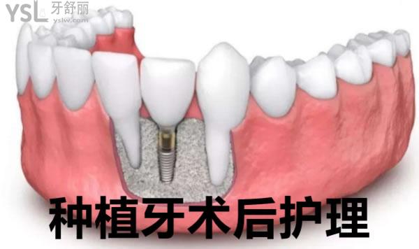 種植牙術(shù)后護理