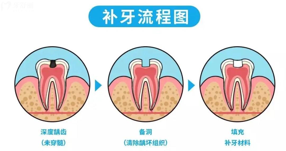 補(bǔ)牙流程圖