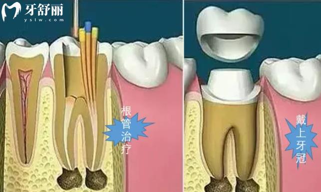 根管治療