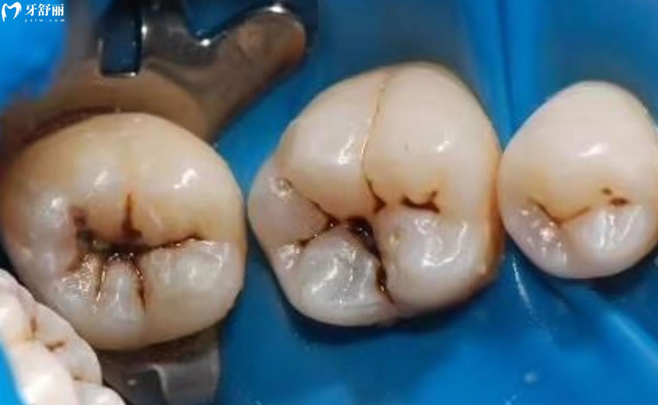 蟲牙是牙齒的蟲子嗎圖片