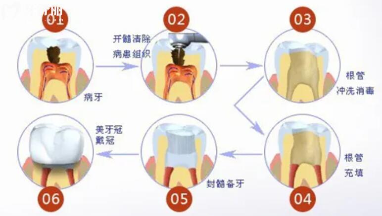 做過(guò)根管治療的牙齒多久可以吃辣