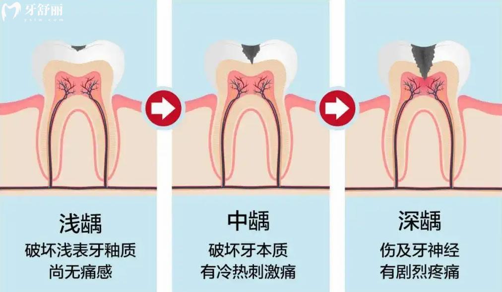 齲齒發(fā)展過程