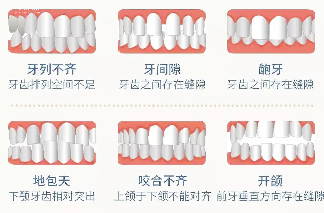牙套究竟怎么選擇好壞，什么樣的人像我一樣需要正畸呢