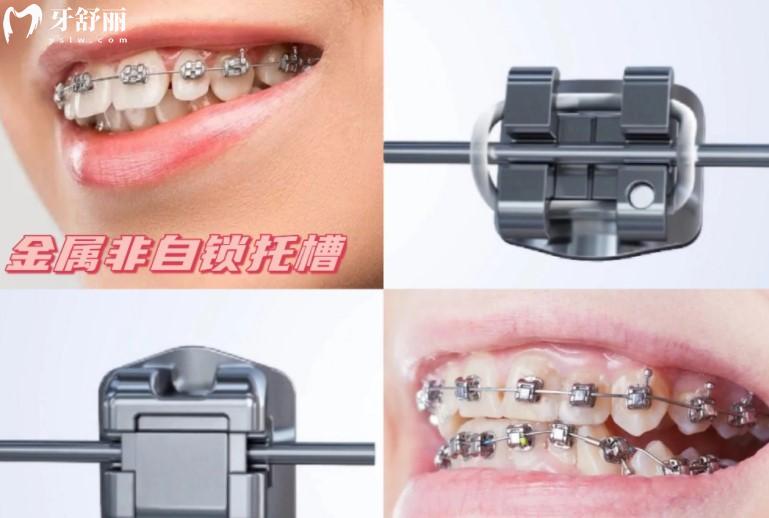 傳統(tǒng)牙套和自鎖牙套對比