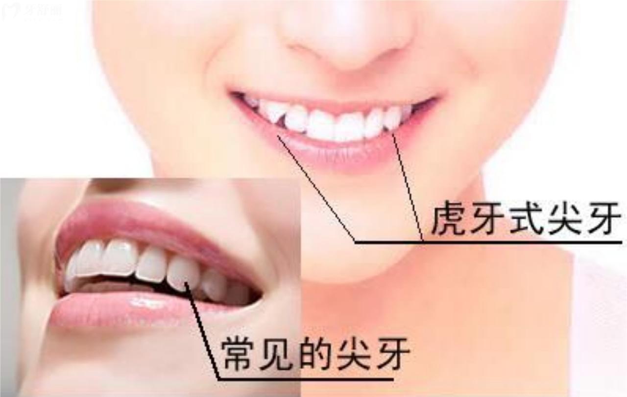 虎牙