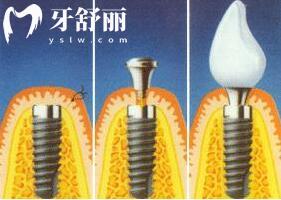 瑞士iti種植牙是什么檔次的?瑞士士卓曼種植牙多少錢(qián)一顆.jpg