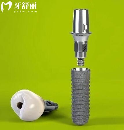 瑞士iti種植牙是什么檔次的?瑞士士卓曼種植牙多少錢(qián)一顆.jpg