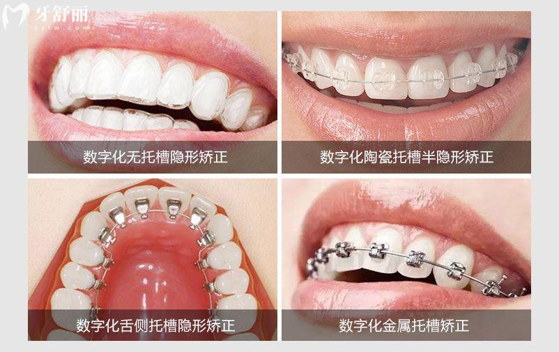 牙齒矯正不同方式