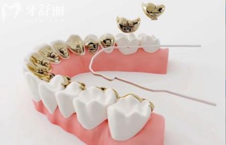 eBrace易美舌側(cè)矯正