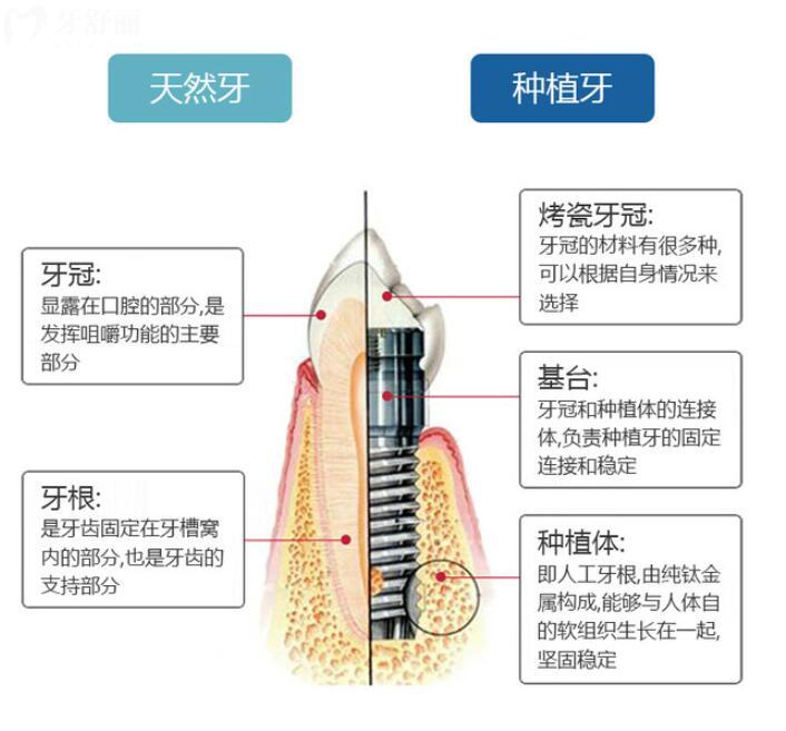 重慶種植牙集采價(jià)格是真的實(shí)在降了嗎？可能要打七折