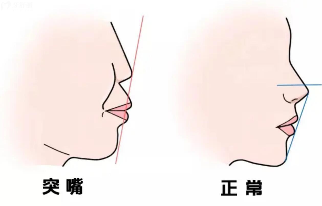 孩子有點齙牙需要矯正嗎？