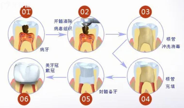 牙齒缺失了一小塊怎么辦