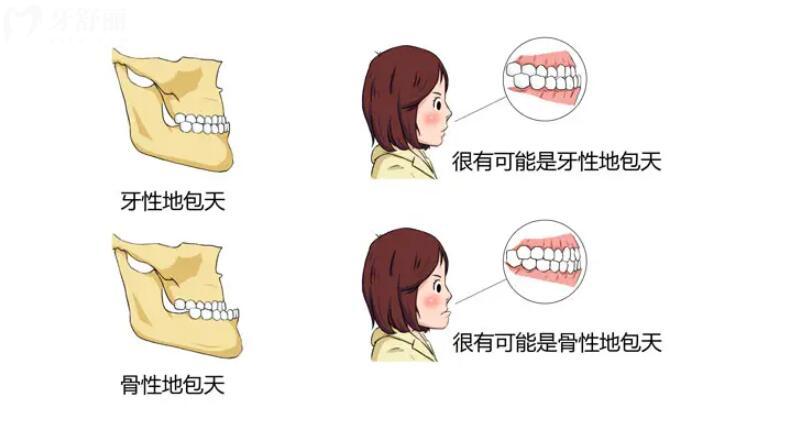 兒童骨性地包天能矯正過來嗎