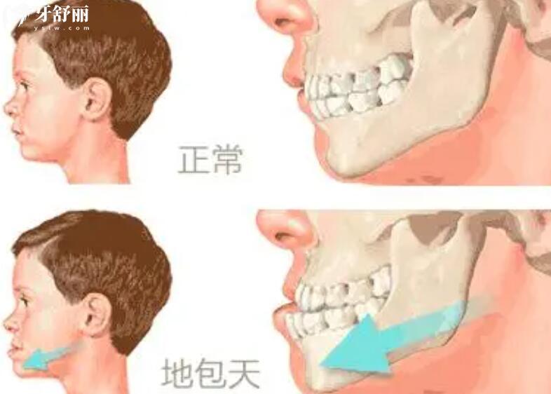 兒童骨性地包天能矯正過來嗎