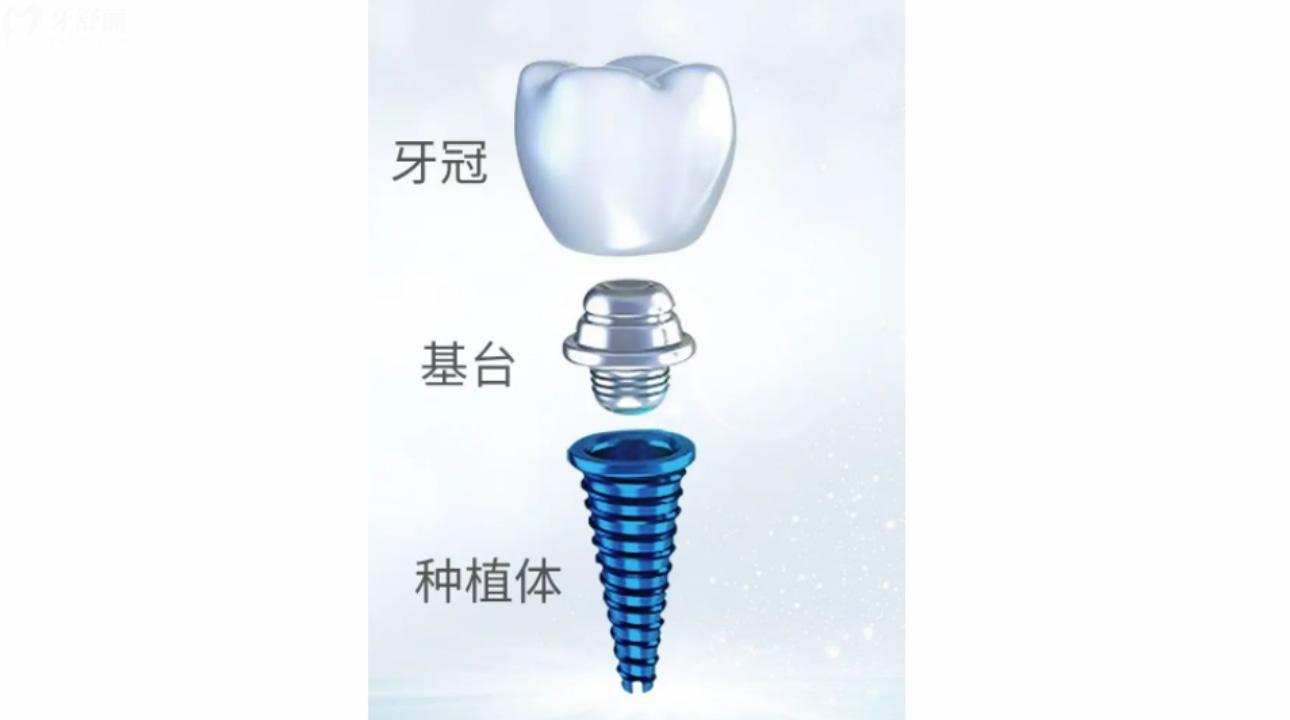 韓國(guó)種植牙品牌有哪些?價(jià)格和優(yōu)勢(shì)是什么?