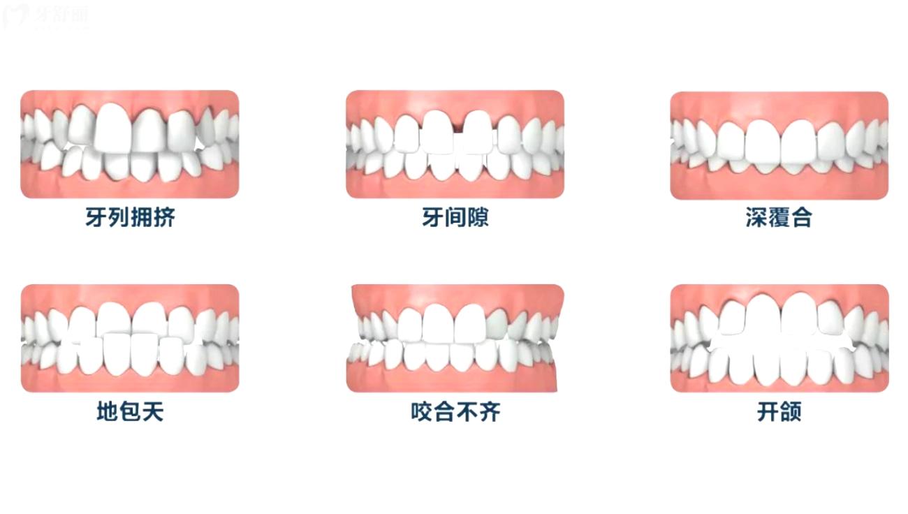 北海牙齒矯正大概要花費多少錢.jpg