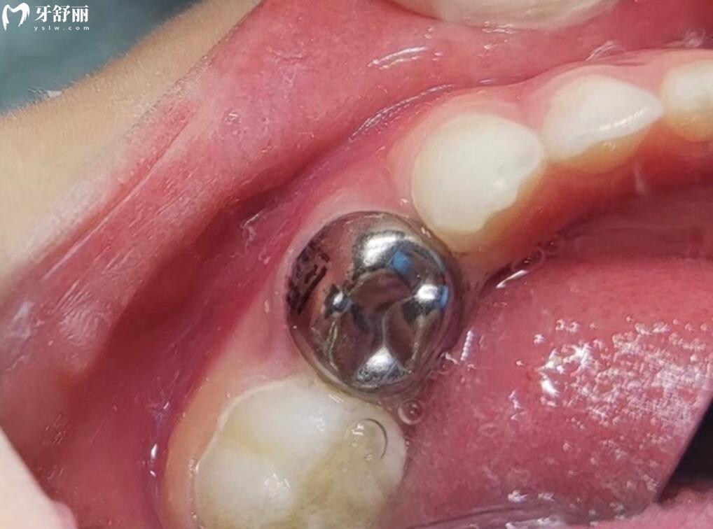 預成冠