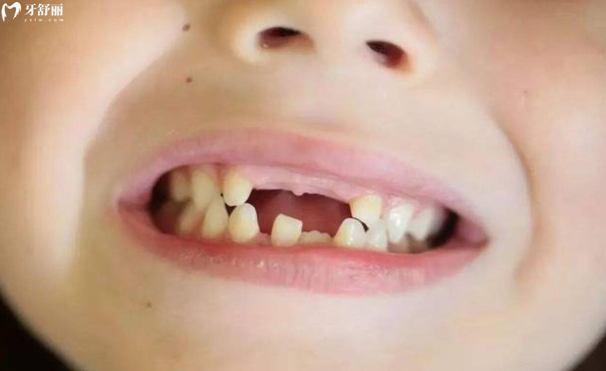 7歲小孩牙齒掉了一直不長怎么辦？是不是永遠(yuǎn)也不會(huì)長了