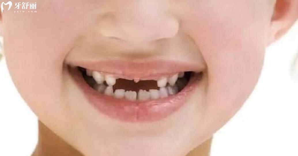 7歲小孩牙齒掉了一直不長怎么辦？是不是永遠(yuǎn)也不會(huì)長了