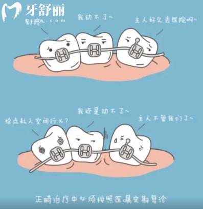 牙齒矯正免費(fèi)，牙齒矯正器的種類及價(jià)格