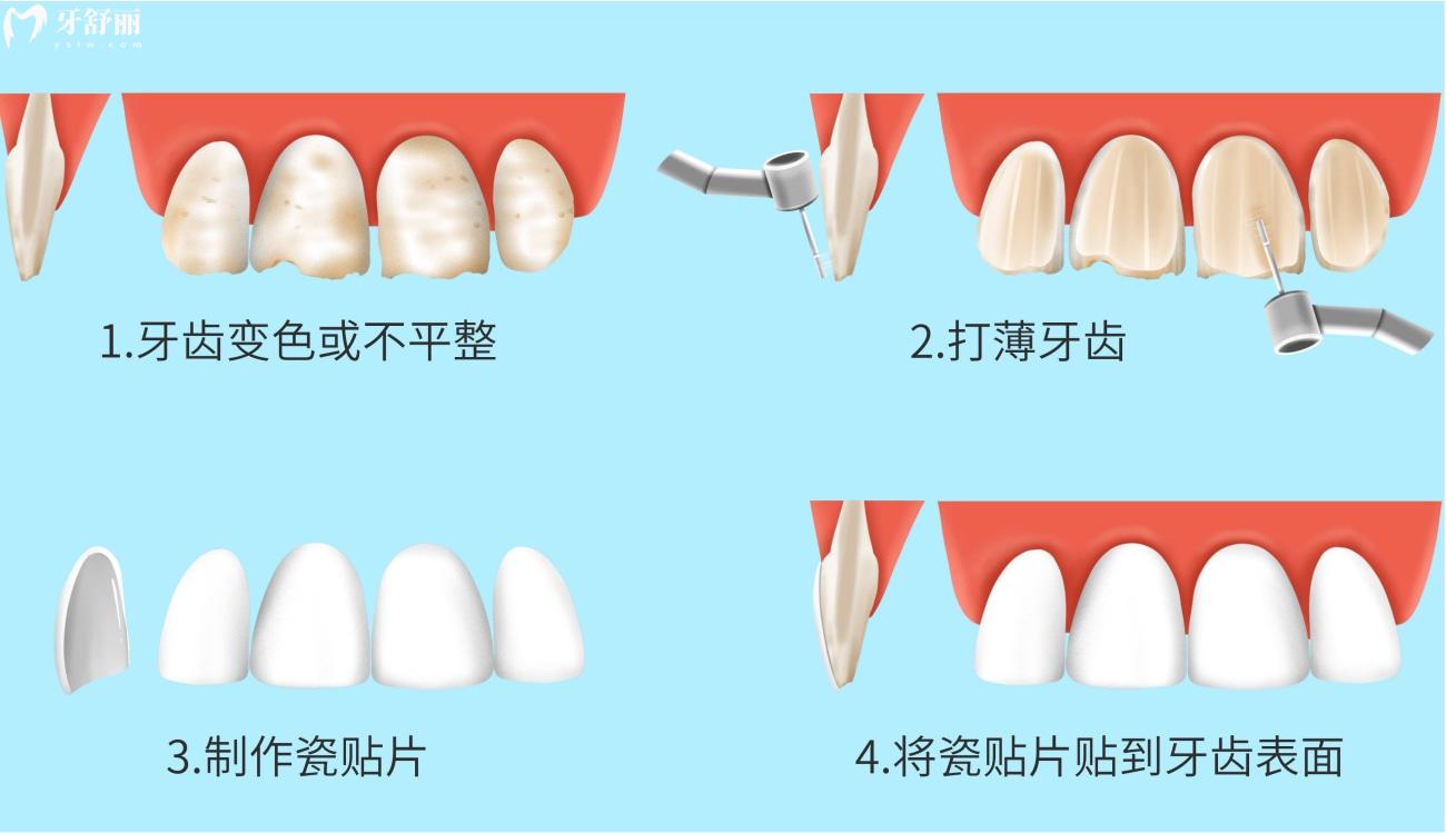 門(mén)牙從側(cè)面掉了一半能補(bǔ)上嗎.jpg