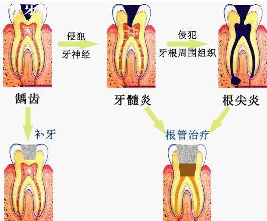牙疼為何如此劇烈，牙疼的原因到底是什么？