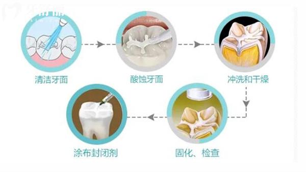 窩溝封閉