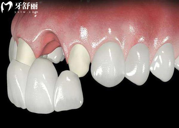愛爾創(chuàng)全瓷牙的優(yōu)點(diǎn)