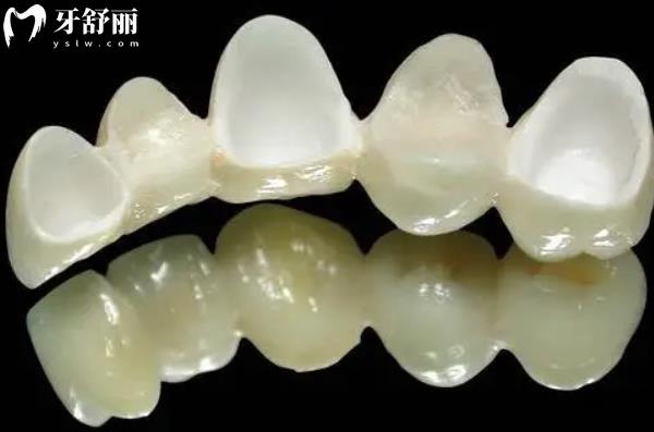 愛爾創(chuàng)全瓷牙